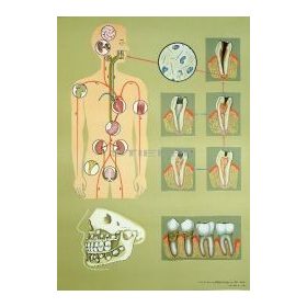 A hiányos fogápolás oktatótabló