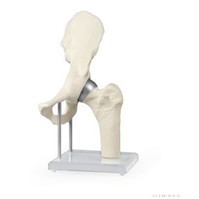 Csípőízület implantátummal