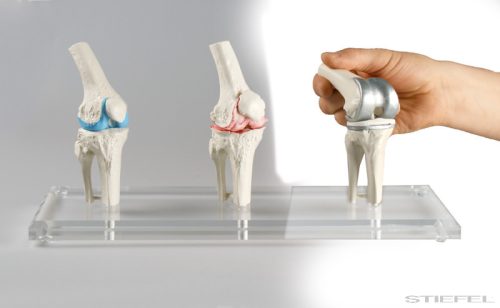 Térd implantátum modell