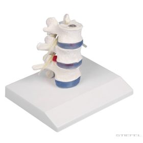   Ágyéki csigolyák prolapsált csigolyaközi lemezekkel, talpon