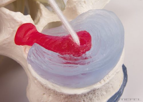 Ágyéki csigolyák prolapsált csigolyaközi lemezekkel, talpon