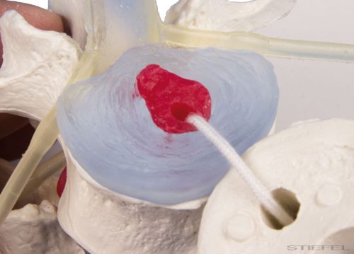 Ágyéki csigolyák prolapsált csigolyaközi lemezekkel, talpon