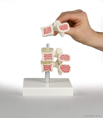 Csigolya modell, csontritkulással, 3 csigolya