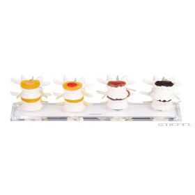 Lemezdegeneráció szakaszai