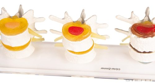 Lemezdegeneráció szakaszai