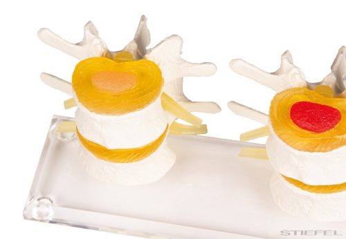 Lemezdegeneráció szakaszai