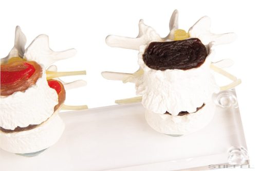 Lemezdegeneráció szakaszai