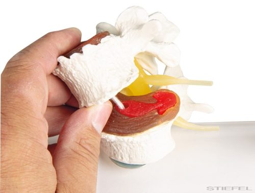 Lemezdegeneráció szakaszai