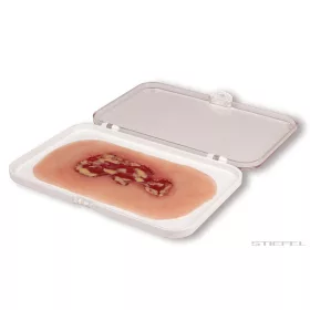 Sebesedés, vénás lábszárfekély, váladékozási fázis
