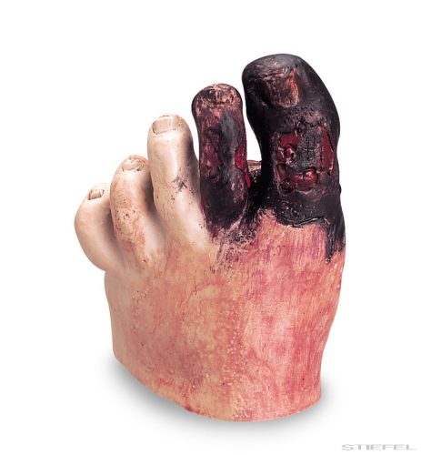 Egészségtelen lábfej modell